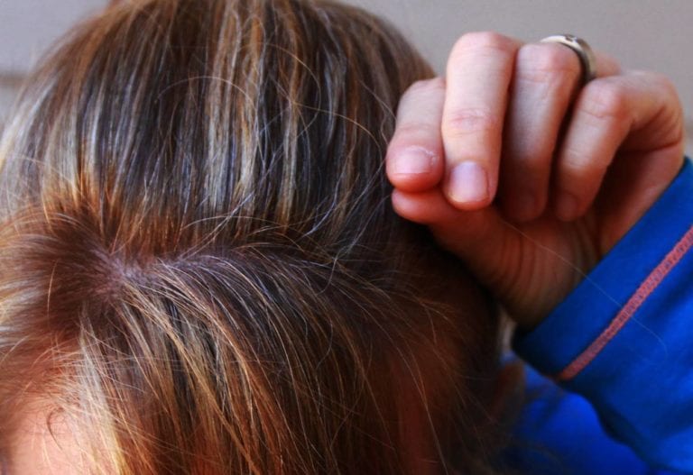 6 Signs You May Need a Hair Transplant
